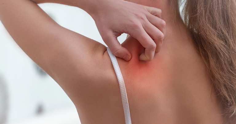 Krostki na ramionach – co oznaczają i jak się ich pozbyć?