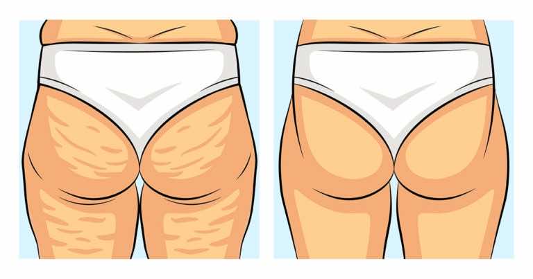 Dermatolodzy dają wskazówki jak faktycznie zredukować cellulit