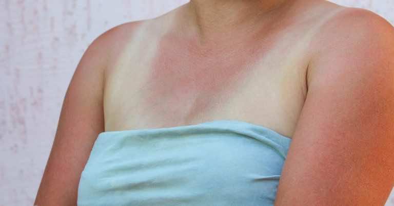 W swojej kuchni masz coś co złagodzi oparzenia słoneczne