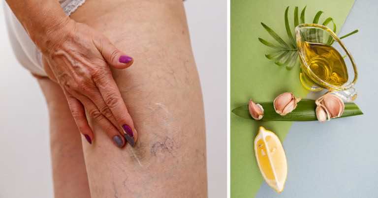 Niesamowita maść na żylaki, którą zrobisz z domowych składników