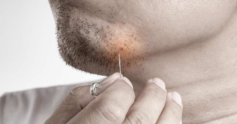 Domowy sposób na wrastające włosy