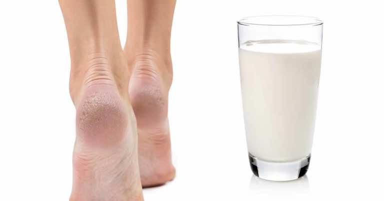 Mleko na popękane i suche pięty