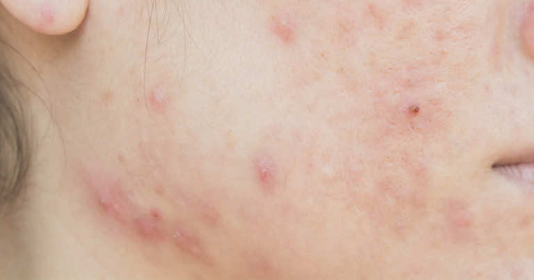 Maseczka na trądzik z węgla aktywnego