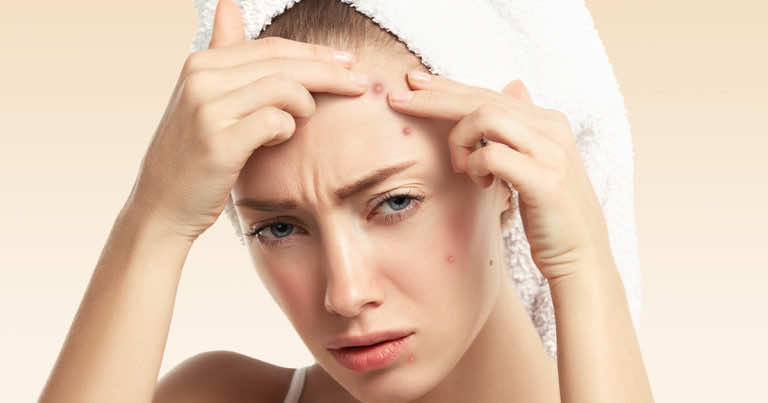 5 domowych sposobów na pryszcze! Jak szybko pozbyć się pryszcza?