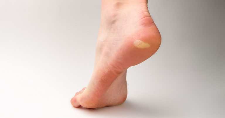 Cały dzień w szpilkach? Domowe sposoby na odciski na stopach.