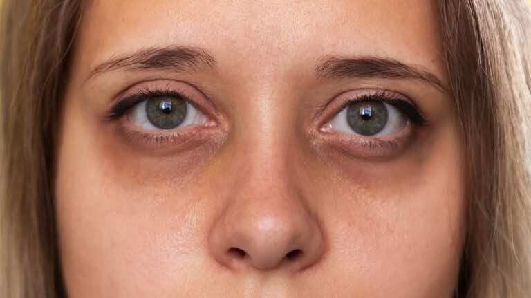 Jak zlikwidować cienie pod oczami?