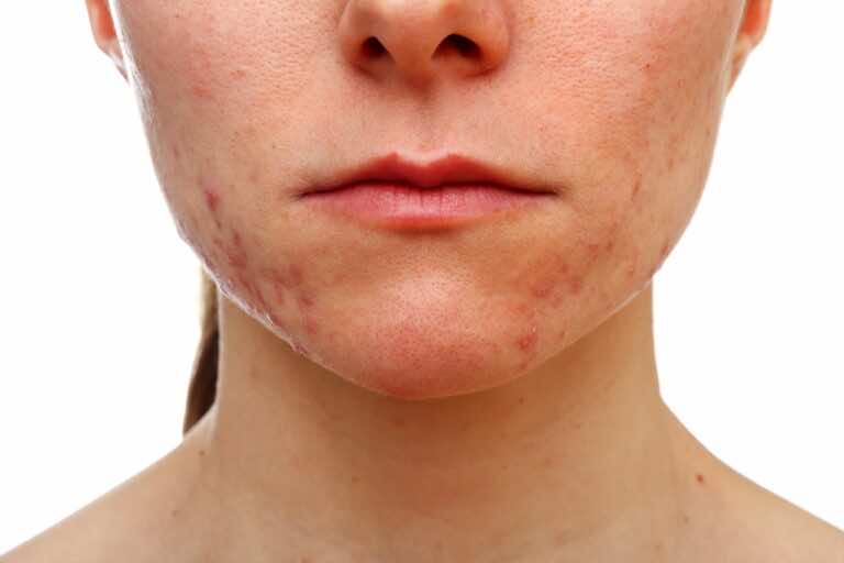 Skuteczne sposoby na zniwelowanie widoczności przebarwień i blizn po trądziku