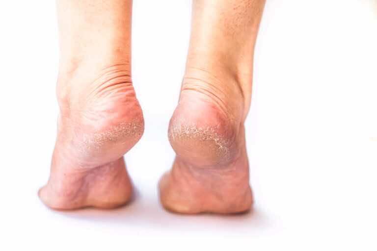 Nigdy więcej popękany pięt! Tania i sprawdzona domowa kuracja.