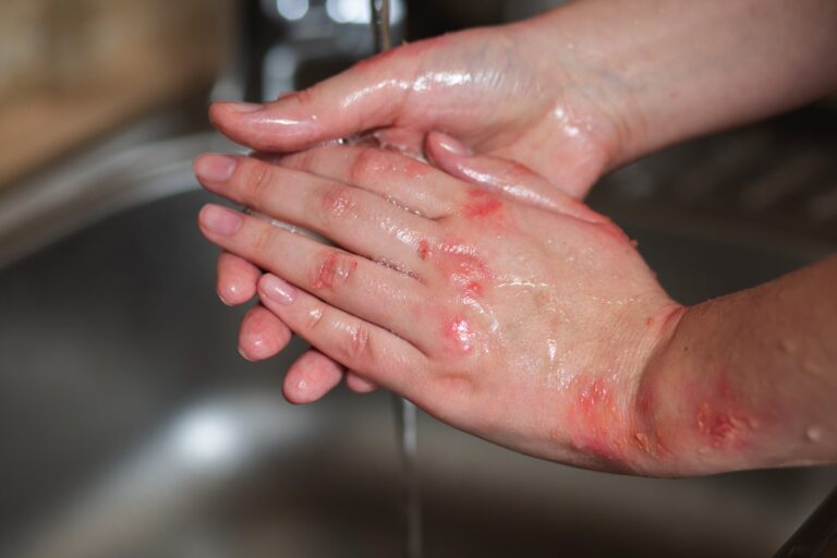 Dłonie mówiące o zdrowiu — siedem chorób odczytywanych z ich wyglądu